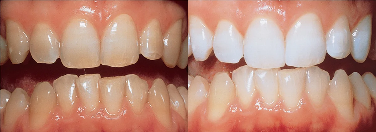 Dokumentiertes Opalescence-PF-Beispiel: links vorher, rechts nachher