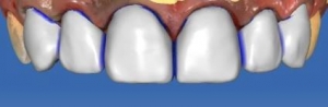 cerec vollkeramikkrone