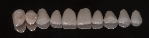 veneers