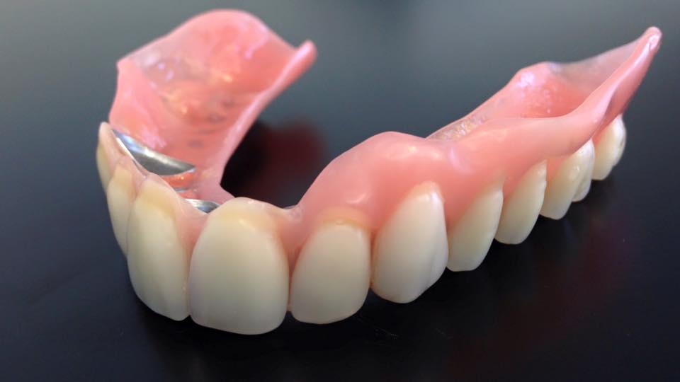 Oberkiefer erfahrungen klammerprothese Zahnbehandlung Ungarn