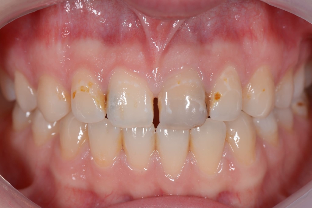 Karies Cosmetic Dental Ihr Zahnarzt in Essen Rüttenscheid Karies Cosmetic Dental Ihr Zahnarzt in Essen Rüttenscheid