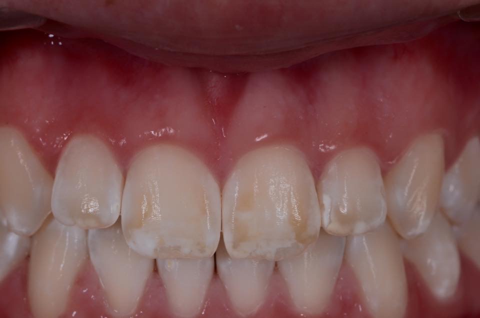 Zahn Verfärbung