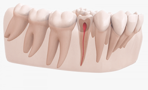 Resorption der Zähne