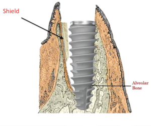 Implantatpflege