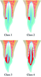 zervikale Resorption