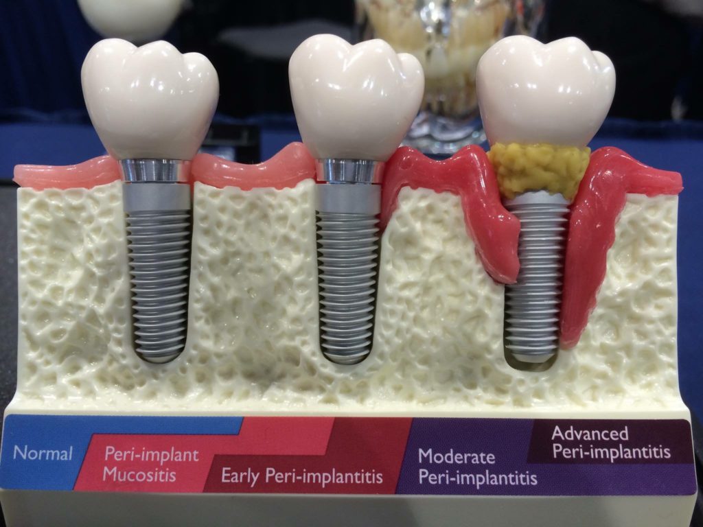 Mukositis Periimplantitis Zahnarzt Dr. Hayim in Essen Rüttenscheid