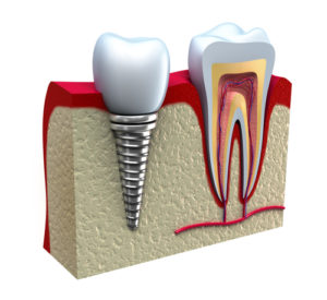 mukositis periimplantitis