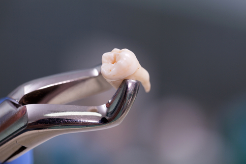 Zahnentfernung, Zahnarzt in Essen Rüttenscheid